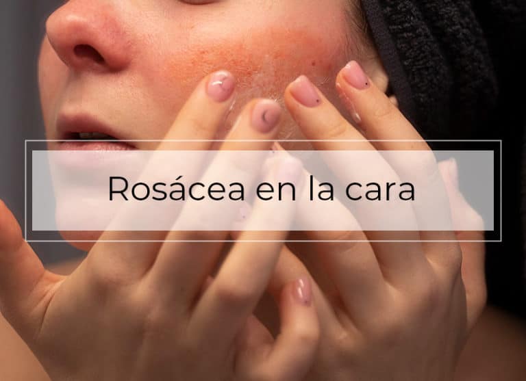 Rosácea En La Cara ¿qué Es Y Cómo Tratarla