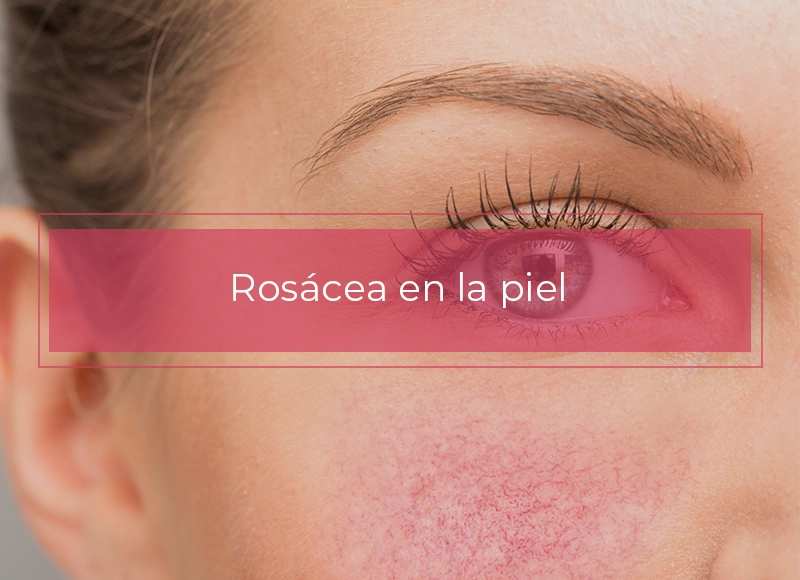 Rosácea en la piel